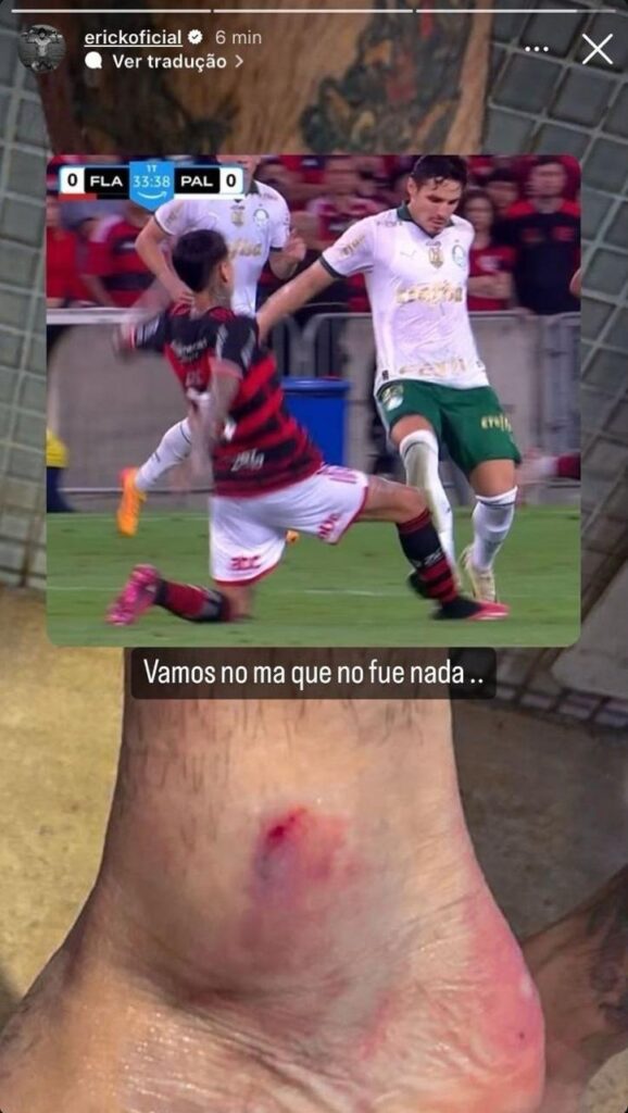 Tornozelo do Pulgar, do Flamengo, após jogo contra o Palmeiras